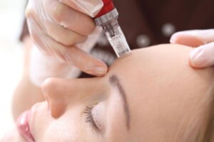 Mesotherapy on face