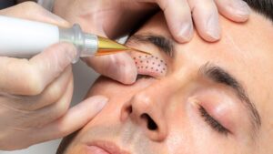 Plasma pen for eyelid rejuvenation - tightening