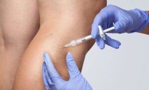 sclerotherapy - vein removal in Perth